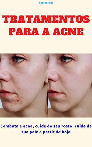 Livro PDF: Tratamentos para a acne: Combata a acne, cuide do seu rosto, cuide da sua pele a partir de hoje